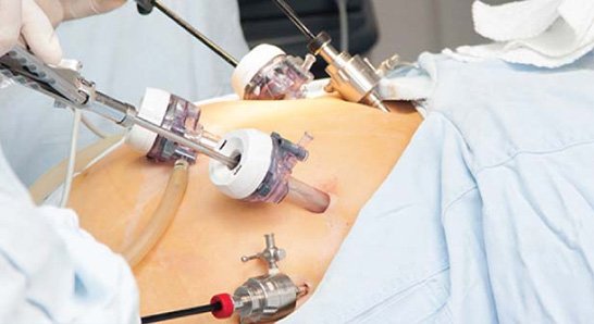 Caesarean Delivery Image